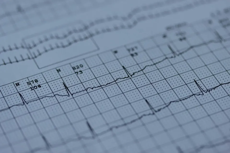 Elektrokardiogramm (EKG) – Illustration